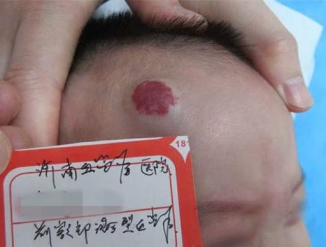 员工查出血管瘤要求不上夜班遭解雇自媒体揭秘，员工查出血管瘤要求调整工作被拒后遭解雇真相揭秘